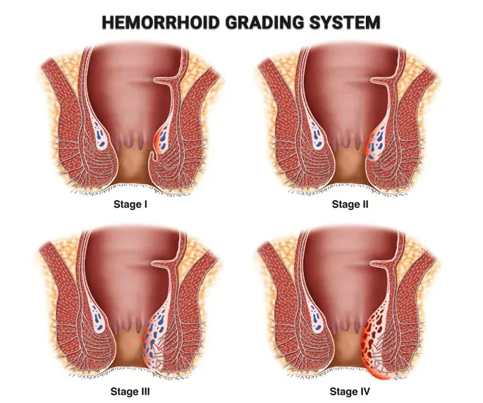 hemorrhoid grading