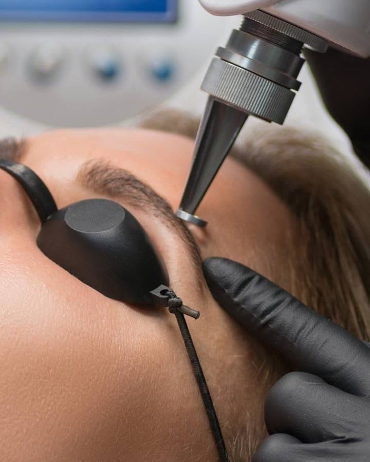 Tattoo Removal at Soins et Beauté