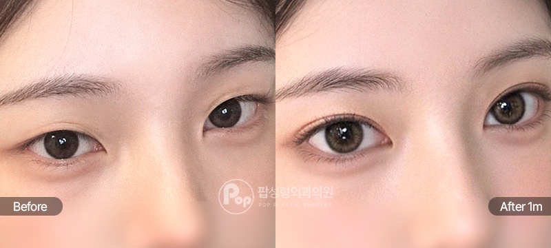 12홀 자연유착, 윗트임, 앞트임 수술 전과 수술 후 1개월차 눈매 경과 비교 이미지