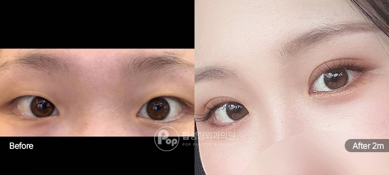 12홀 자연유착, 윗트임, 밑트임 수술 전과 수술 후 2개월차 눈매 경과 비교 이미지