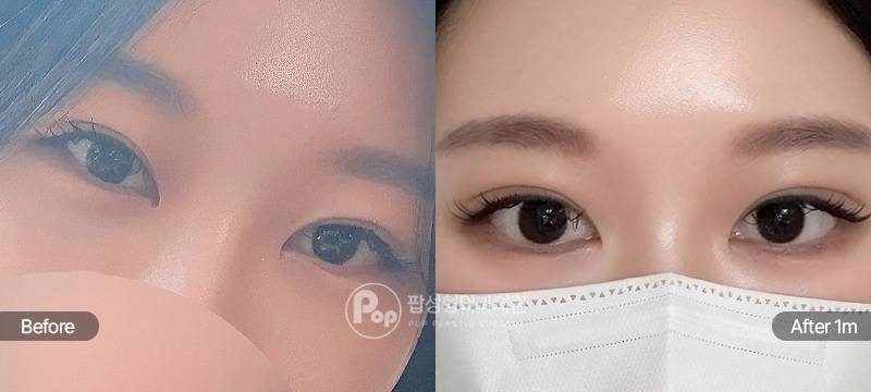 12홀 자연유착, 눈매교정, 뒤트임, 밑트임 눈재수술 전과 수술 후 1개월차 눈매 경과 비교 이미지