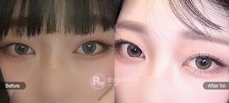 12홀 자연유착과 눈밑지방재배치 수술 전과 수술 후 1개월차 눈매 및 눈밑 경과 비교 이미지