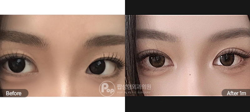 12홀 자연유착, 눈매교정, 눈위지방이식 수술 전과 수술 후 1개월차 눈매 경과 비교 이미지