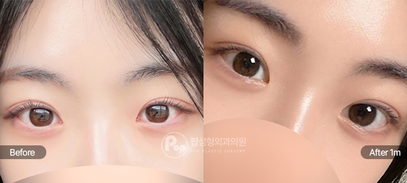 12홀 자연유착과 눈매교정 수술 전과 수술 후 1개월차 눈매 경과 비교 이미지