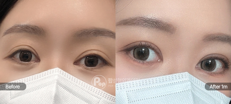 12홀 자연유착과 눈매교정 눈재수술 전과 수술 후 1개월차 눈매 경과 비교 이미지