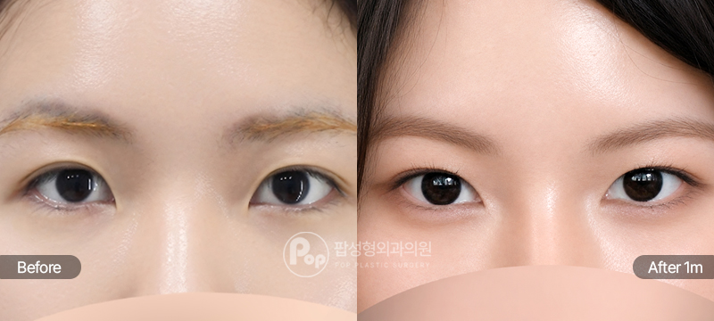 윗트임과 앞트임 수술 전과 수술 후 1개월차 눈앞머리 및 눈매 경과 비교 이미지