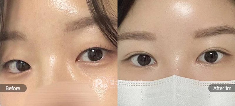 12홀 자연유착, 눈매교정, 윗트임, 앞트임 수술 전과 수술 후 1개월차 눈매 경과 비교 이미지