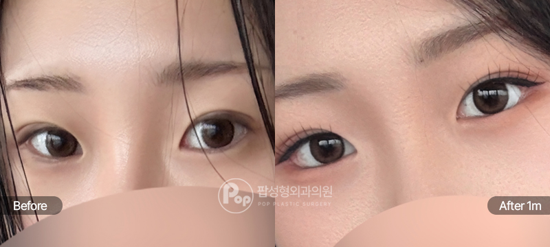 뒤트임과 밑트임 수술 전과 수술 후 1개월차 눈꼬리 및 뒷눈매 경과 비교 이미지
