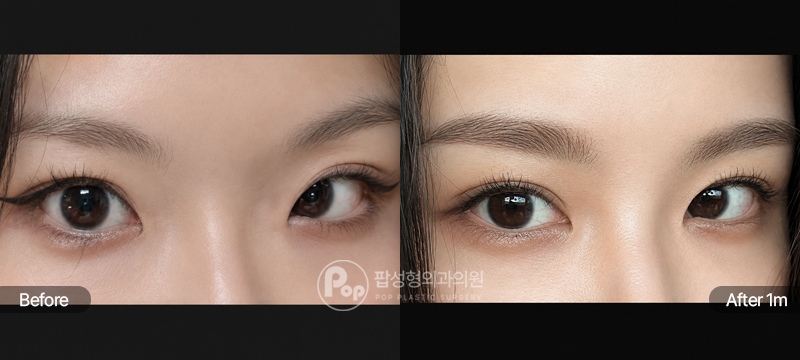 12홀 자연유착과 윗트임, 앞트임 수술 전과 수술 후 1개월차 눈매 경과 비교 이미지