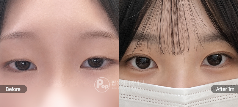 12홀 자연유착과 눈매교정 수술 전과 수술 후 1개월차 눈매 경과 비교 이미지