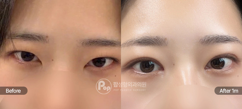 12홀 자연유착, 눈매교정, 앞트임, 윗트임 눈재수술 전과 수술 후 1개월차 눈매 경과 비교 이미지