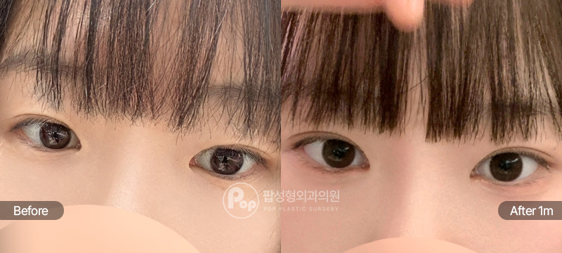 12홀 자연유착과 앞트임, 윗트임 수술 전과 수술 후 1개월차 눈매 경과 비교 이미지