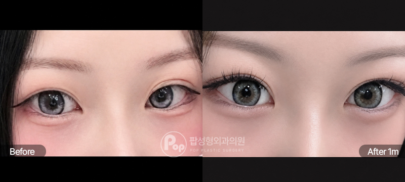 12홀 자연유착과 눈매교정, 윗트임 눈재수술 전과 수술 후 1개월차 눈매 경과 비교 이미지