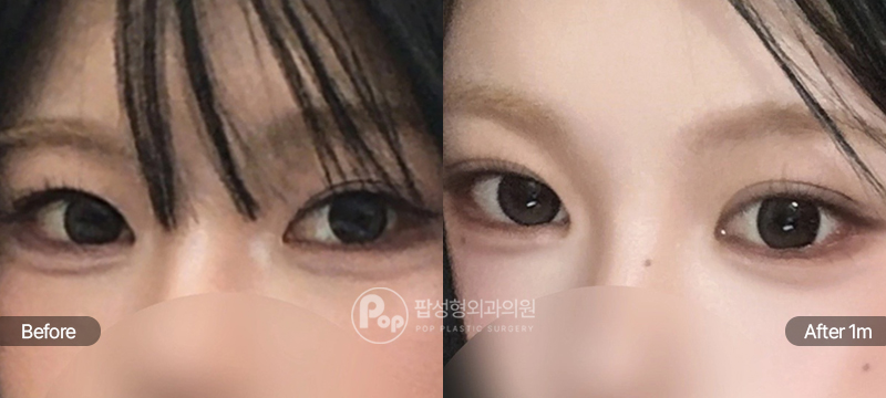 팝성형외과 12홀 자연유착과 밑트임 눈재수술 전후 1개월차 눈매 비교 이미지
