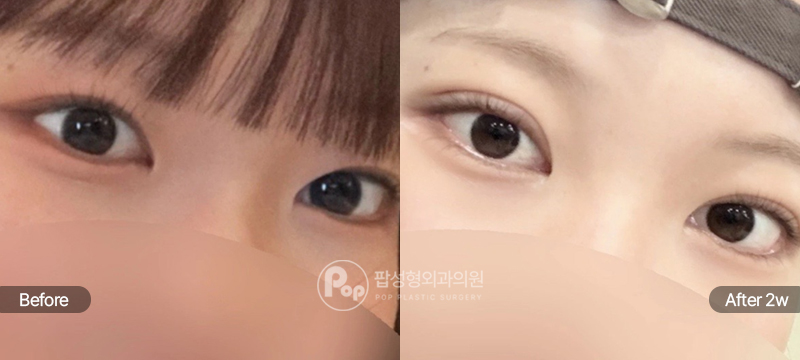 팝성형외과 12홀 자연유착 눈재수술 전후 2주차 쌍꺼풀 라인 비교 이미지