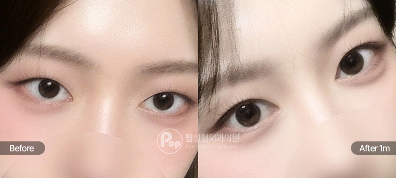 팝성형외과 12홀 자연유착과 윗트임 수술 전후 1개월차 눈매 비교 이미지