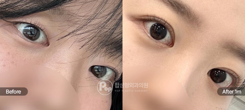팝성형외과 12홀 자연유착과 눈매교정 수술 전후 1개월차 눈매 비교 이미지
