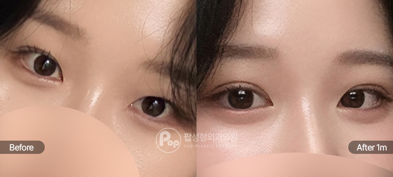 팝성형외과 12홀 자연유착과 윗트임 밑트임 뒤트임 눈재수술 전후 1개월차 눈매 비교 이미지