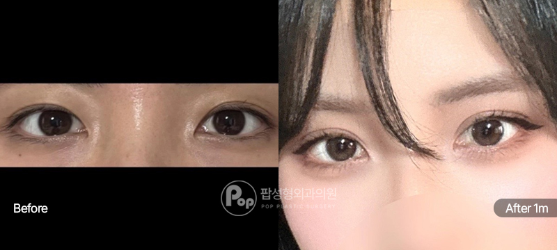 팝성형외과 12홀 자연유착 눈매교정 윗트임 수술 전후 1개월차 눈매 비교 이미지
