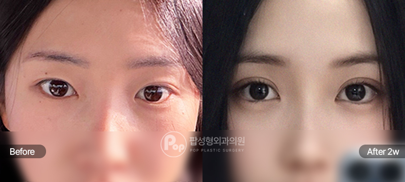 팝성형외과 12홀 자연유착 윗트임 앞트임 뒤트임 밑트임 눈재수술 전후 2주차 눈매 비교 이미지