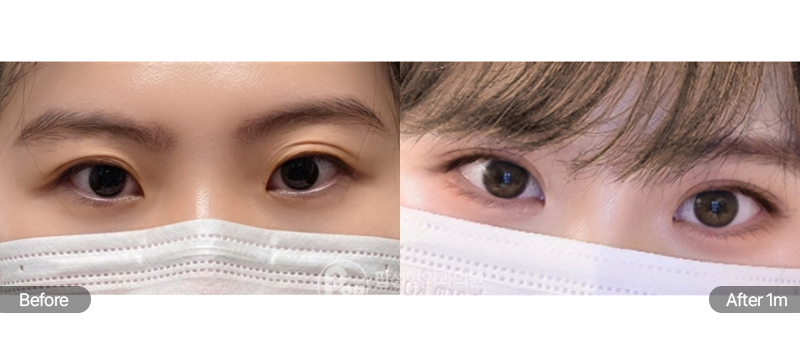 팝성형외과 12홀 자연유착과 윗트임 수술 전후 3개월차 눈매 비교 이미지
