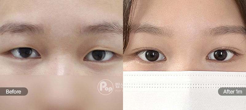 팝성형외과 12홀 자연유착 눈매교정 윗트임 수술 전후 1개월차 눈매 비교 이미지