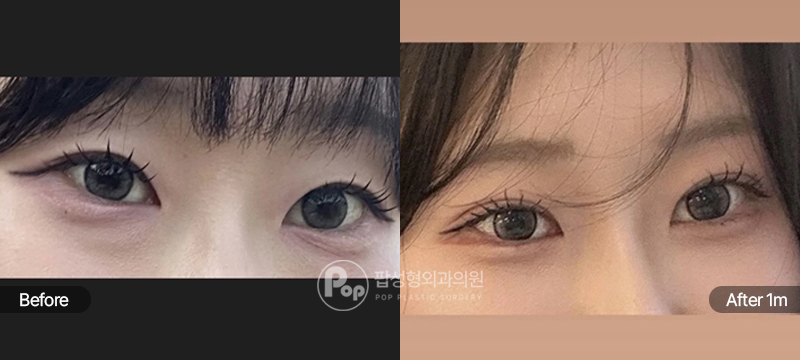 팝성형외과 12홀 자연유착 눈매교정 윗트임 눈밑지방재배치 전후 1개월차 비교 이미지