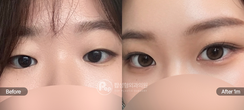 팝성형외과 12홀 자연유착 눈매교정 윗트임 앞트임 눈위지방제거 전후 1개월차 눈매 비교 이미지