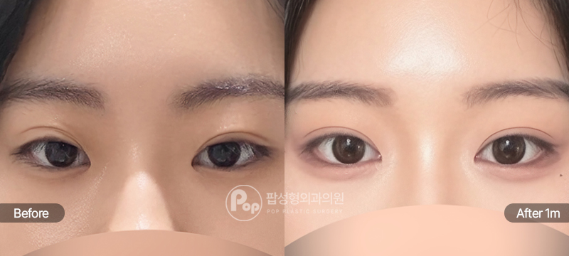 팝성형외과 12홀 자연유착 윗트임 앞트임 눈재수술 전후 1개월차 눈매 비교 이미지