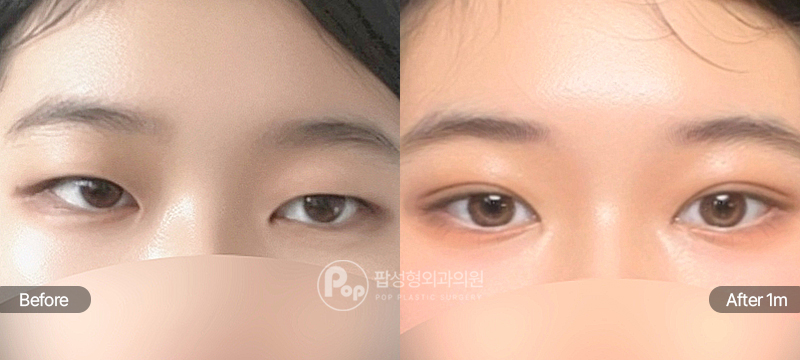 팝성형외과 12홀 자연유착 눈매교정 윗트임 앞트임 수술 전후 1개월차 눈매 비교 이미지
