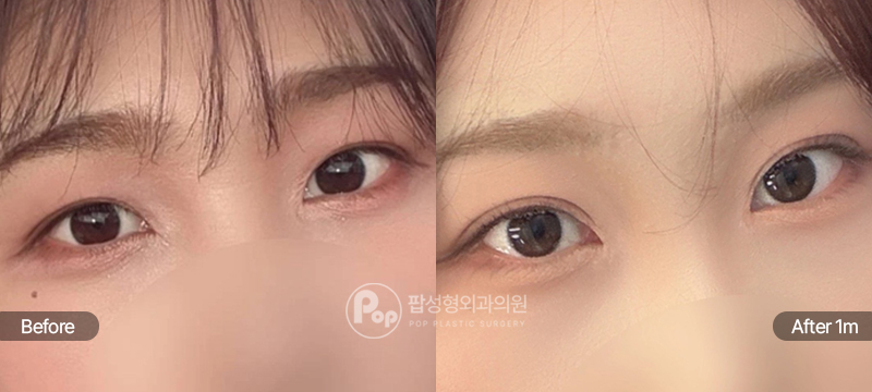팝성형외과 12홀 자연유착 눈매교정 윗트임 눈재수술 전후 1개월차 눈매 비교 이미지
