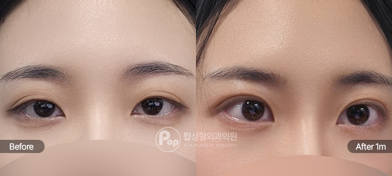 팝성형외과 12홀 자연유착과 눈매교정 수술 전후 1개월차 눈매 비교 이미지