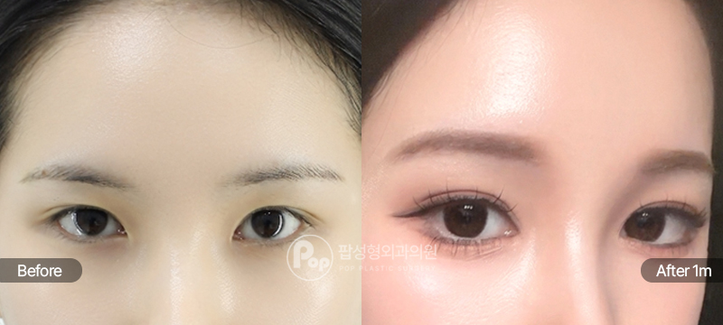 팝성형외과 이마거상 12홀 자연유착 윗트임 수술 전후 1개월차 눈매 비교 이미지