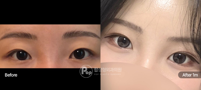 팝성형외과 12홀 자연유착 눈매교정 윗트임 수술 전후 1개월차 눈매 비교 이미지