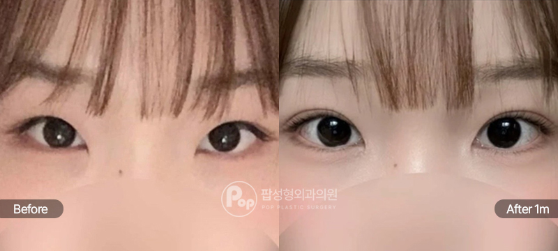 팝성형외과 12홀 자연유착 눈매교정 윗트임 앞트임 수술 전후 1개월차 눈매 비교 이미지