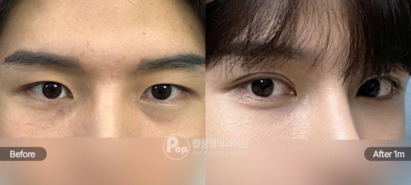 팝성형외과 남자 인라인 12홀 자연유착 수술 전후 1개월차 눈매 비교 이미지