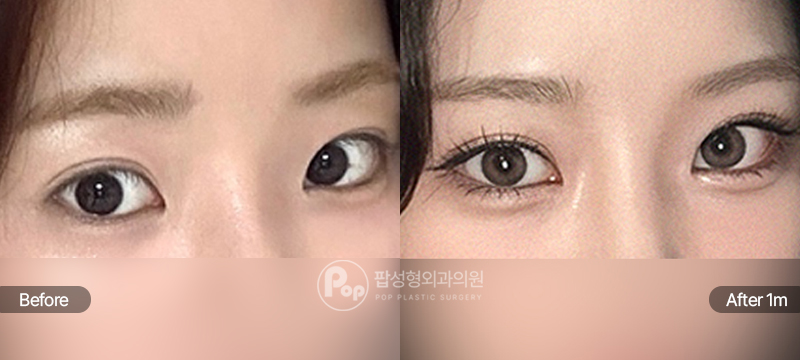 팝성형외과 12홀 자연유착 윗트임 앞트임 뒤트임 밑트임 수술 전후 1개월차 눈매 비교 이미지