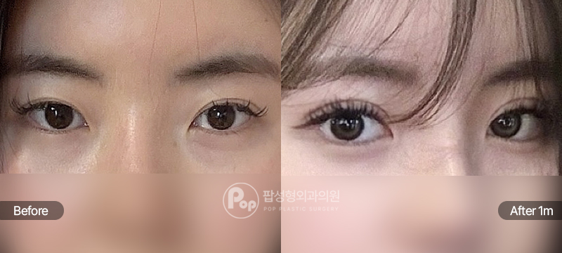 팝성형외과 12홀 자연유착 눈재수술 눈매교정 윗트임 뒤트임 밑트임 수술 전후 1개월차 눈매 비교 이미지