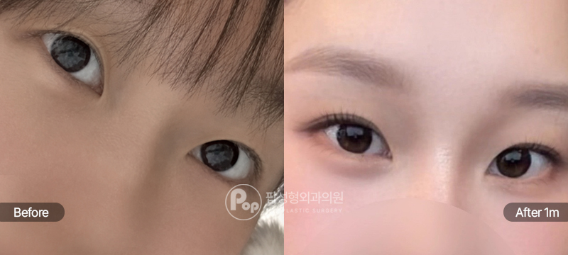 팝성형외과 12홀 자연유착 눈매교정 수술 전후 1개월차 눈매 비교 이미지