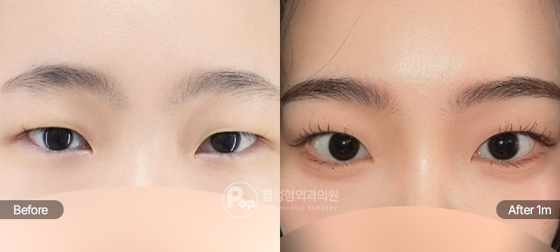 팝성형외과 12홀 자연유착 눈매교정 밑트임 수술 전후 1개월차 눈매 비교 이미지