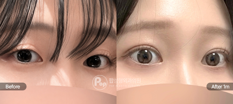 팝성형외과 12홀 자연유착 눈매교정 윗트임 수술 전후 1개월차 눈매 비교 이미지