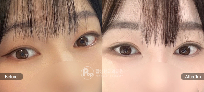 팝성형외과 12홀 자연유착 눈매교정 눈재수술 전후 1개월차 눈매 비교 이미지