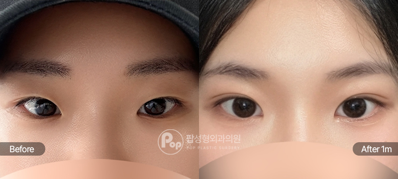 팝성형외과 12홀 자연유착 눈매교정 윗트임 앞트임 수술 전후 1개월차 눈매 비교 이미지
