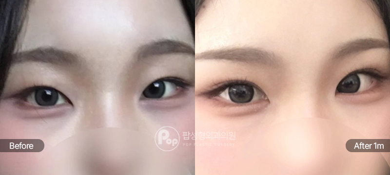 팝성형외과 12홀 자연유착 눈매교정 윗트임 수술 전후 1개월차 눈매 비교 이미지