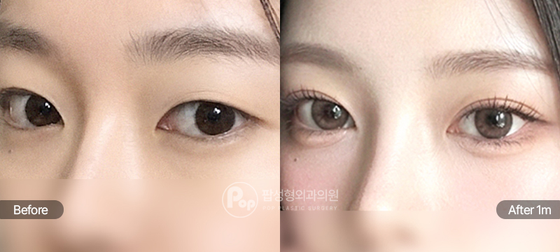 팝성형외과 12홀 자연유착 눈매교정 윗트임 자려한 인아웃라인 수술 전후 1개월차 눈매 비교 이미지