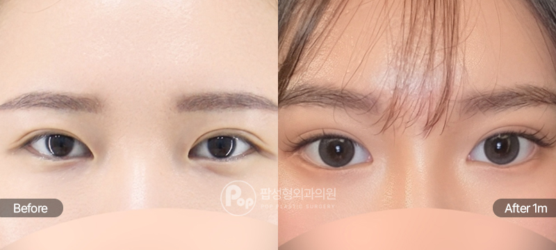 팝성형외과 12홀 자연유착 눈매교정 윗트임 앞트임 밑트임 뒤트임 눈재수술 전후 1개월차 눈매 비교 이미지