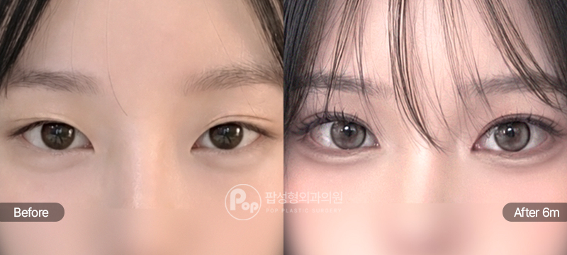 팝성형외과 12홀 자연유착 눈매교정 앞트임 뒤트임 밑트임 수술 전후 6개월차 세미아웃라인 눈매 비교 이미지