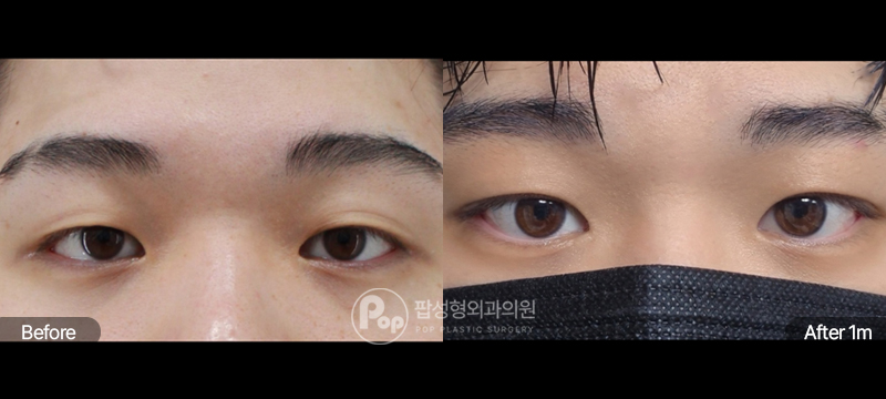 팝성형외과 12홀 자연유착 눈매교정 남자눈성형 수술 전후 1개월차 눈매 비교 이미지