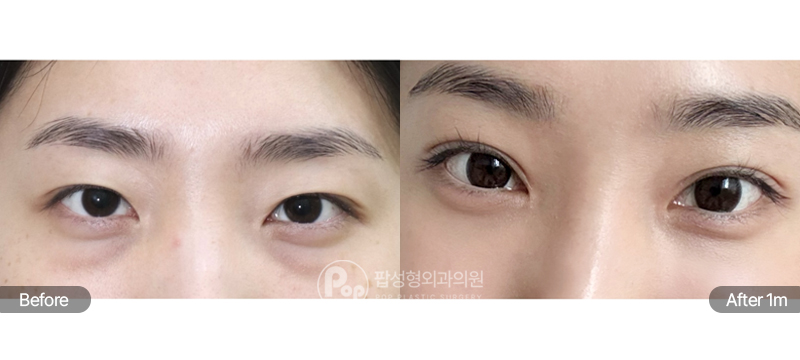 팝성형외과 눈밑지방재배치 12홀 자연유착 수술 전후 1개월차 눈매 비교 이미지
