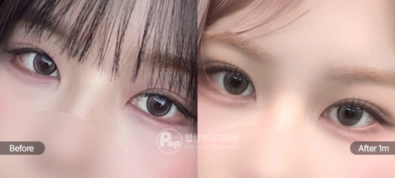 팝성형외과 12홀 자연유착 눈매교정 수술 전후 1개월차 눈매 비교 이미지
